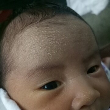 dry skin sa forehead?