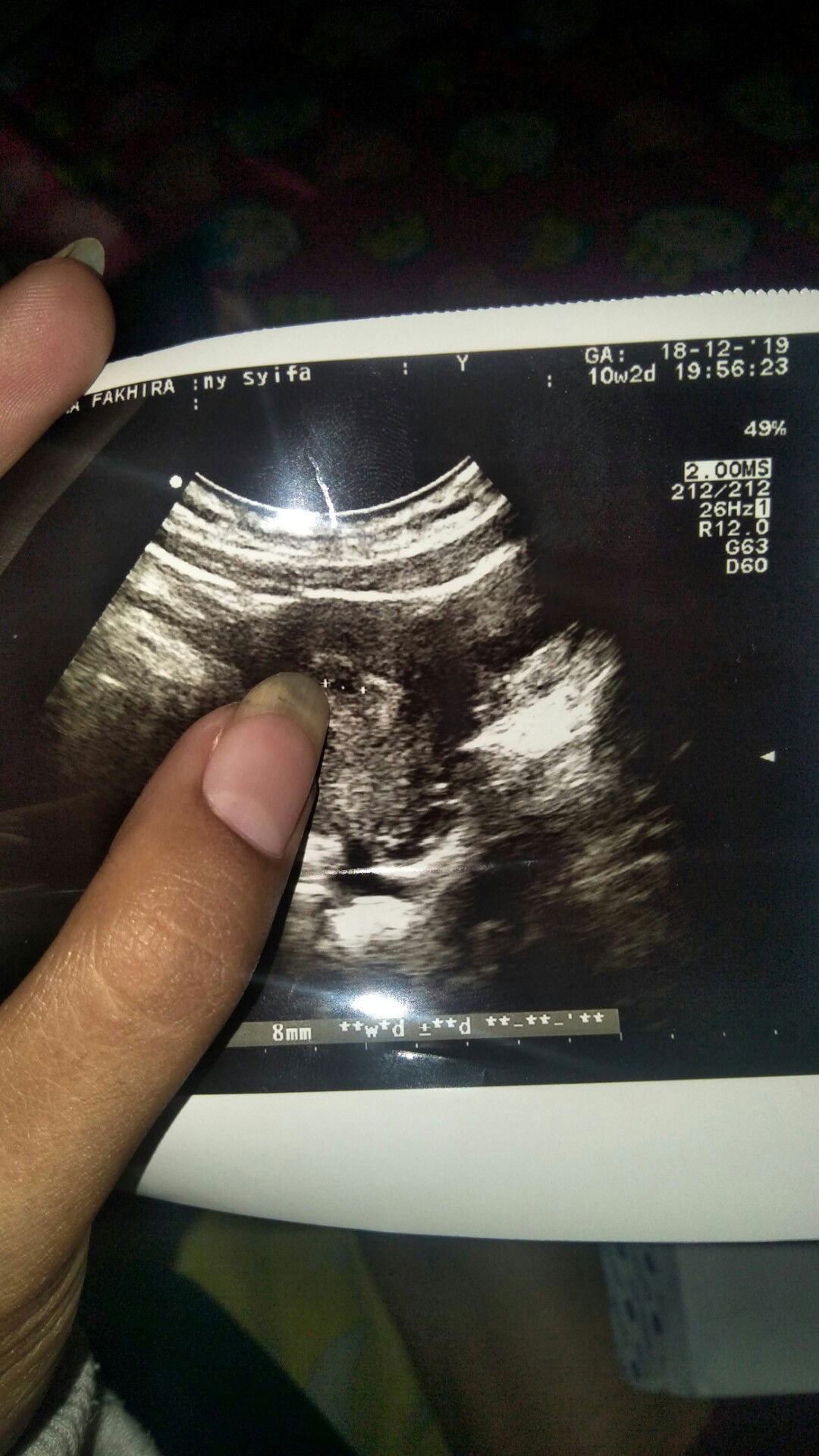 janin cenderung kecil