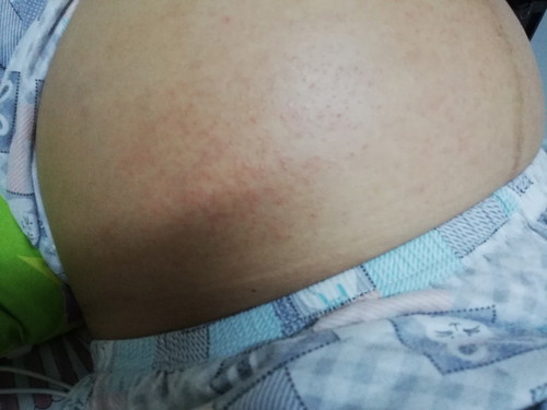 มีผื่นคันที่ท้อง คันมากค่ะ อันตรายมั้ยค่ะ