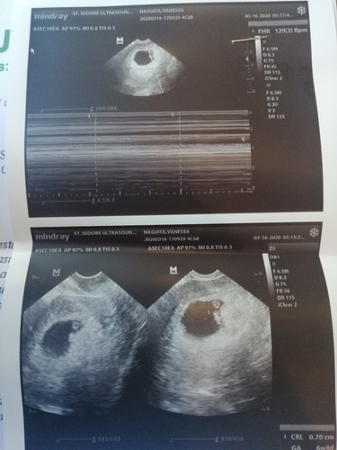 Does minimal subchorionic hemmorage affect the bby?