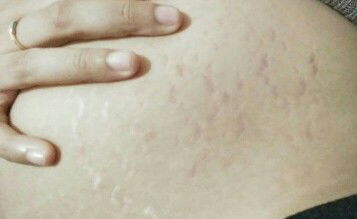Strech mark