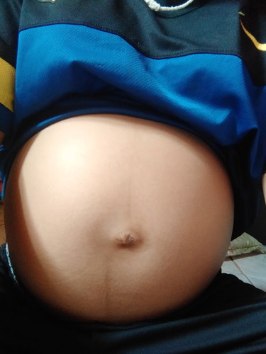 สะดือออก