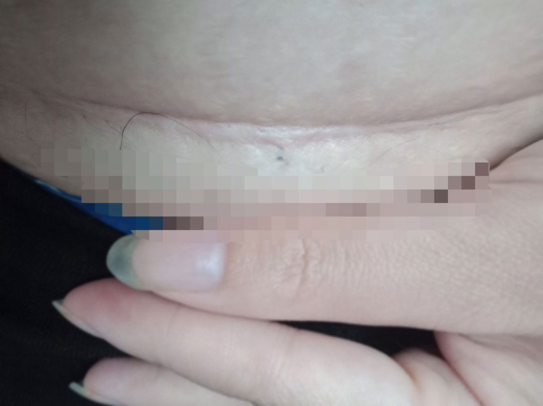 แผลผ่าของท้องแรก