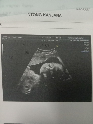 อัลตราซาวนด์ครั้งที่5