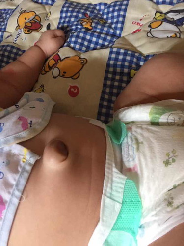 ไส้เลื่อนที่สะดือ !! มีแม่บ้านไหนที่มีลูกน้อยเป็นแบบนี้ที่สะดือบ้างคะ ตอนเเรกหลังจากที่สะดือแห้งและหลุดออก มีติ่งสีแดง โปล่ออกมาแม่ก็ทำการเช็ดปกติ ครั้งแรก เพียงสงสัยว่าสะดือทำไมยังไม่แห้งและปิด แต่พอ