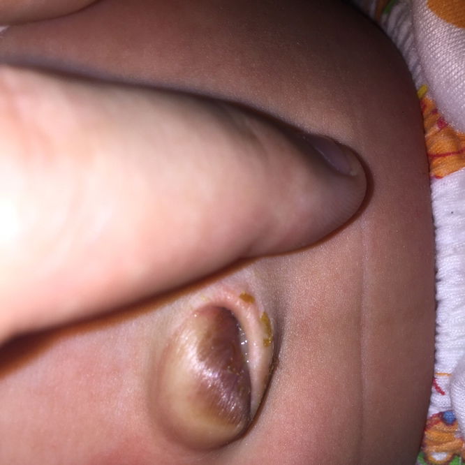 สะดือไม่เเห้ง มีติ่งสีแดง หลังสะดือหลุด สะดือจุ่นออกมา และเริ่มใหญ่ขึ้นทุกวัน