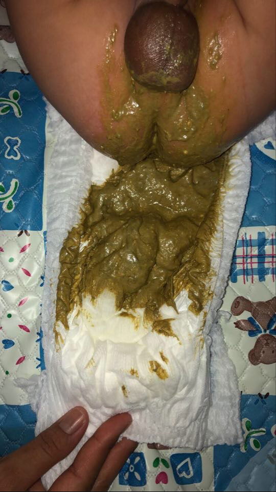 น้องทานนมผงสลับนมแม่แต่ เน้นนมผงเป็นหลักทุกๆ 2 ชม. น้องอายุ 2 เดือนค่ะ น้องจะถ่ายวันละครั้งหรือ เว้นวันถ่าย แต่จะถ่ายมากๆใน 1 ครั้ง แต่ครั้งนี้น้องถ่ายออกมามีสีเขียวขี้ม้า และเหนียวๆมีกลิ่นเหม็น