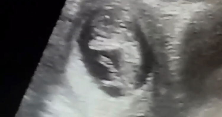 Sharing Kehamilan TM1