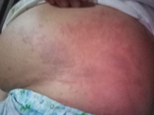skin diseases during pregnancy