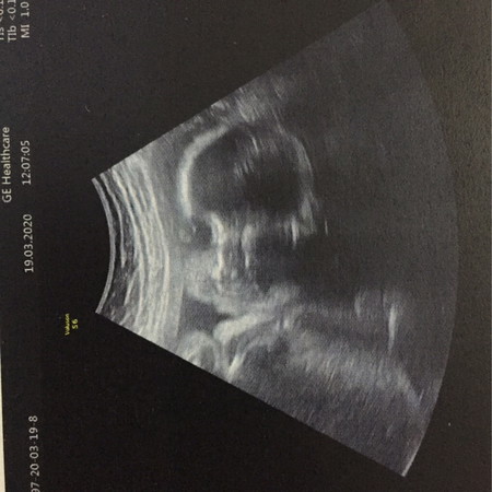 เร่งคลอด