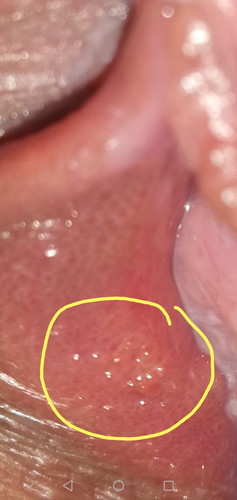 HELP!! GENITAL WARTS!!