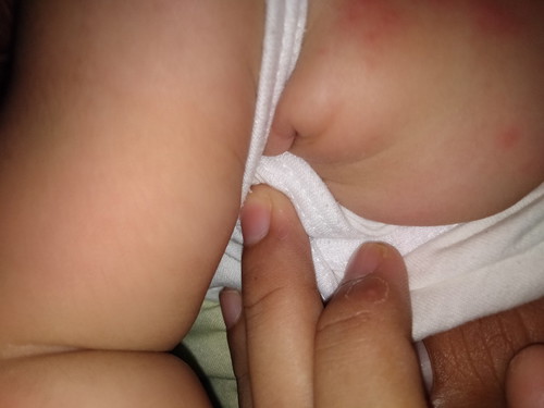 rashes