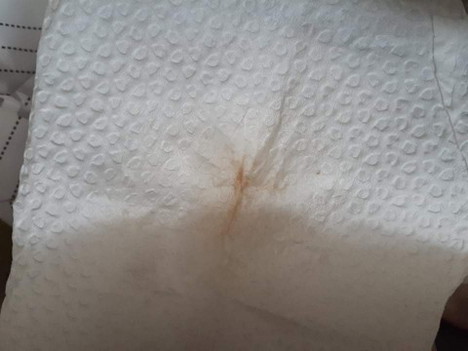 Unusual Discharge