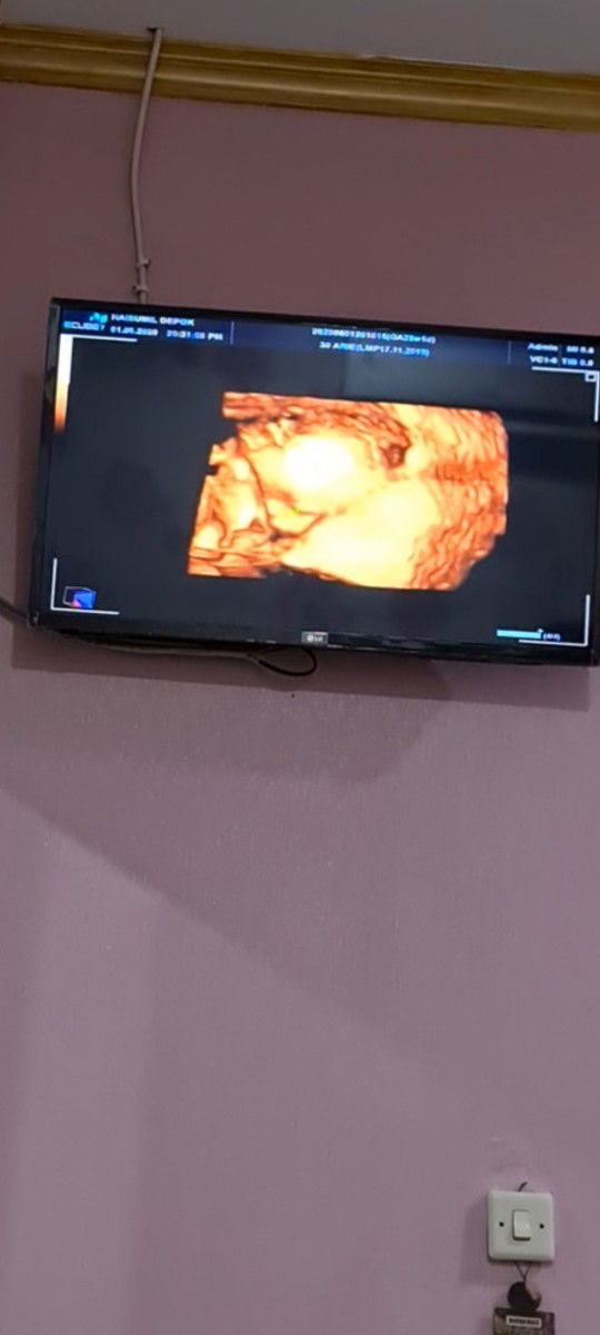 ada ga yg hamil 28minggu posisi bayi masih sungsang