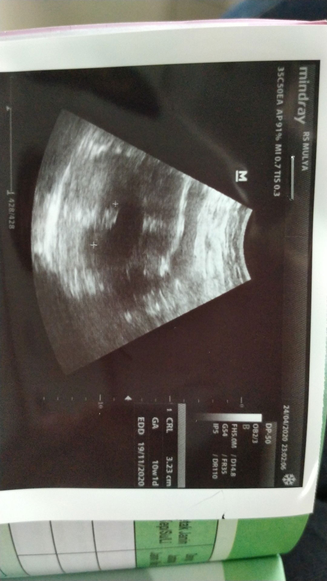 hamil 10 minggu didiagnosis ISK