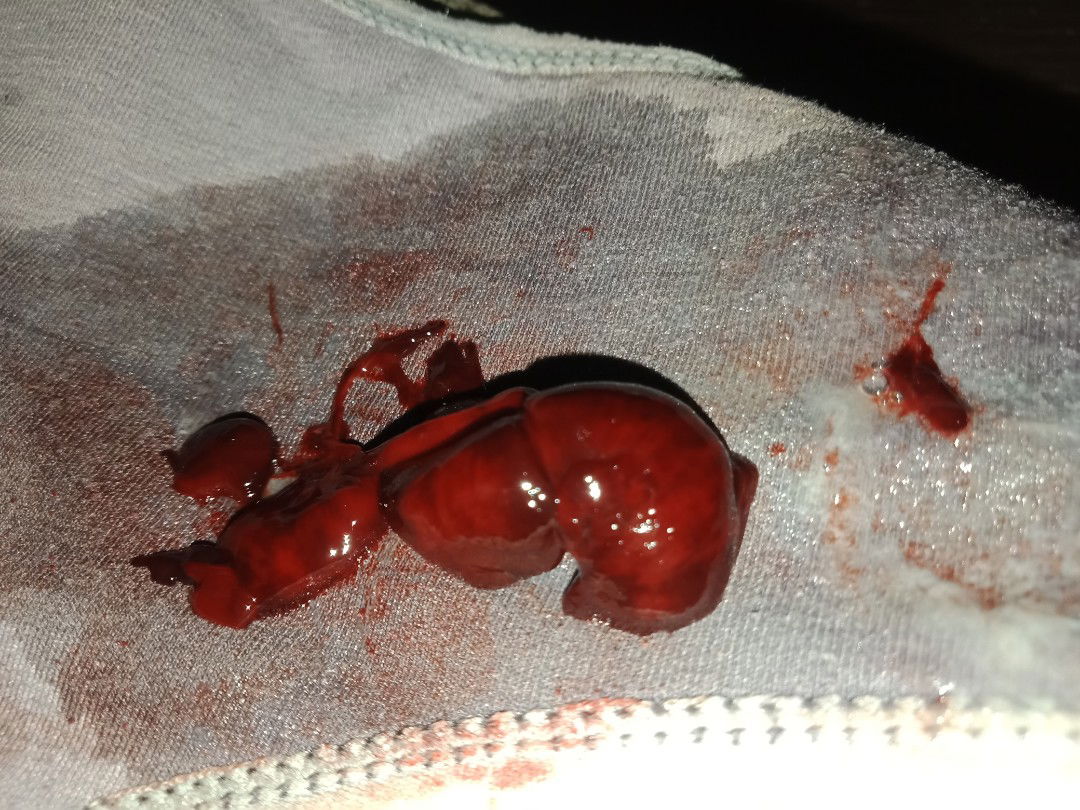 keluar gumpalan darah