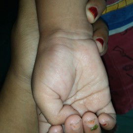 benjolan di pegelangan tangan anak