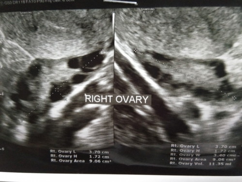 PCOS