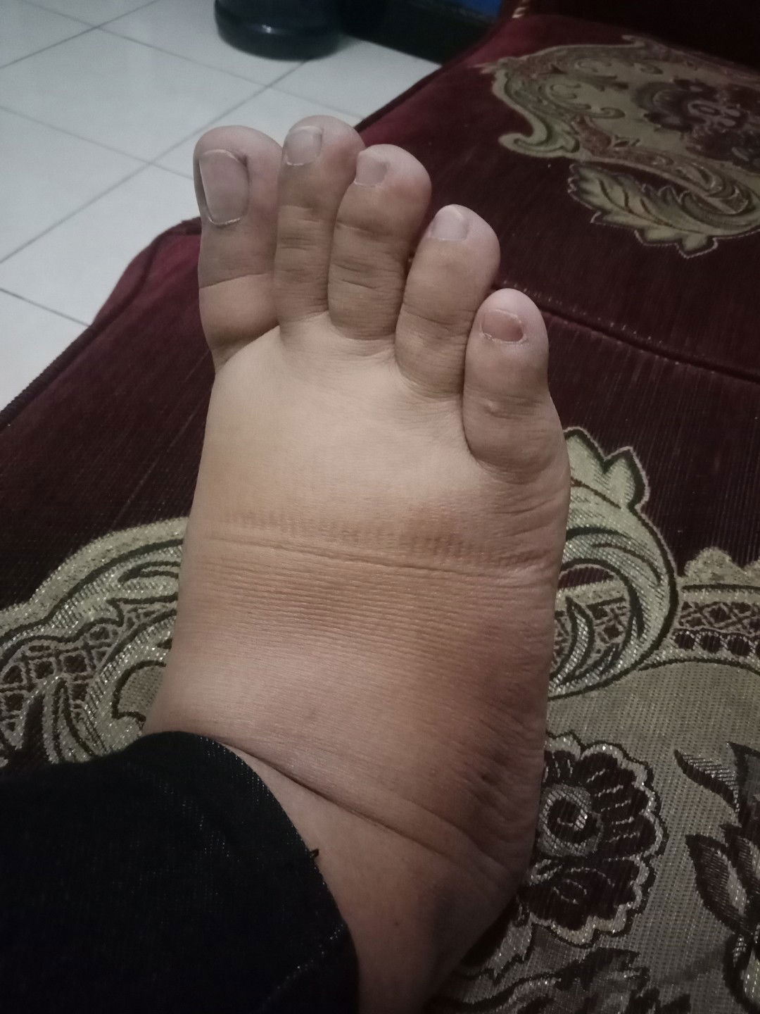 Kaki bengkak