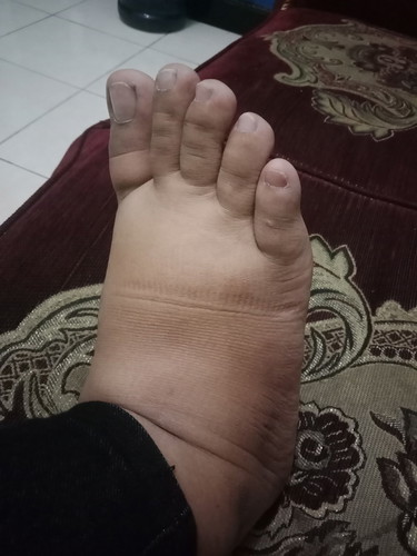 Kaki bengkak