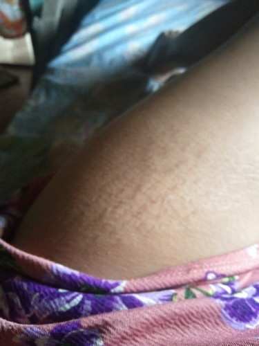 Stretch marks