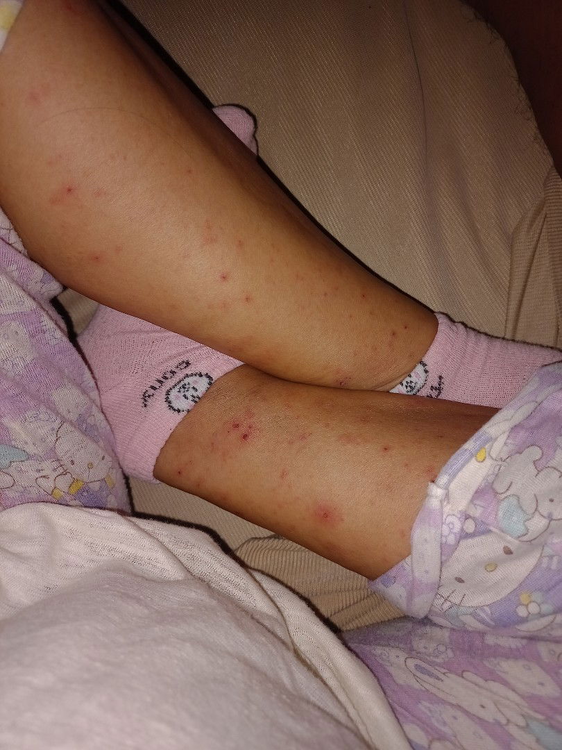 Pangagati ng balat at Pamamanhid ng kamay