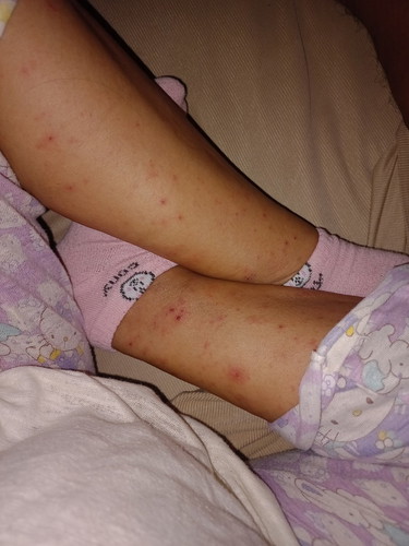 Pangagati ng balat at Pamamanhid ng kamay