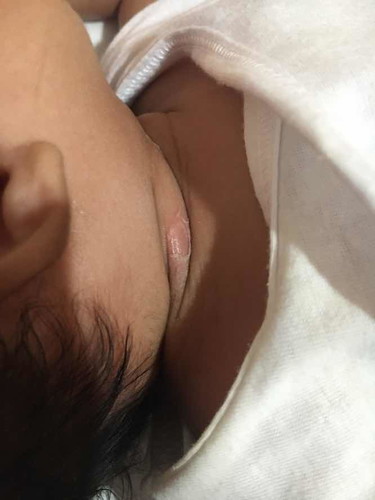 ano po ba dahilan kung bakit nagka ganito sya sa leeg? sa pawis po ba to?