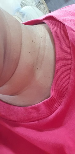 Does anyone had skin nodules/skin tags during their pregnancy?