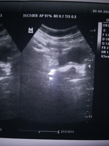 mau tanya bun .?? apa ini hamil kosong tapi kok ada putih" nya . aku udah telat 13 minggu .