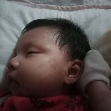 bukol sa bandang kilay ni baby