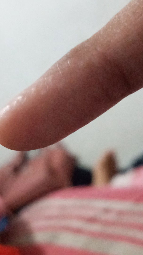 gatal telapak kaki dan tangan