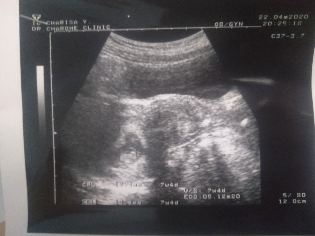 อายุครรภ์ในใบซาวด์ไม่ตรงกับที่นับตาม ประจำเดือน