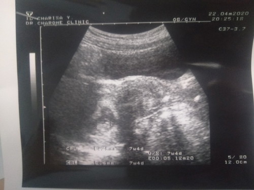 อายุครรภ์ในใบซาวด์ไม่ตรงกับที่นับตาม ประจำเดือน