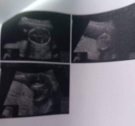 แม่ๆคะ ขอสอบถามคะ ภาพอัลตร้าซาวด์ แบบนี้คือปกติมั๊ยคะ 15 w +6