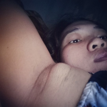 bukol sa kili kili
