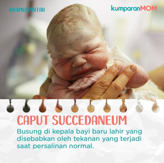 Persalinan SC vs NORMAL