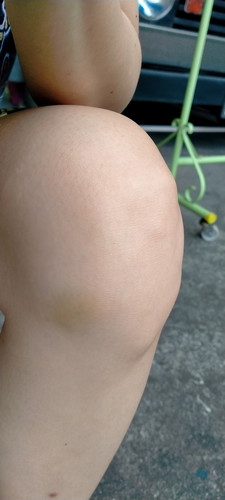 hello doc.i have a very big problem now.last saturday i got dizzy and blocked out and fell down while standing.my knee got badly hurt.until now its a bit swollen and its painful when im moving it or when im walking.its been 5 days now since i got injured.