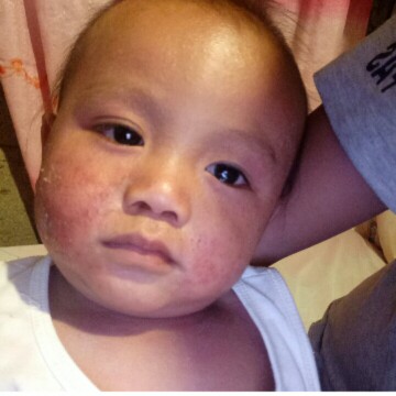 pangangati ng Anak ko