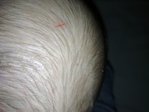 Nasugatan Si Baby Sa Ulo