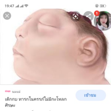 น้องไม่มีกระโหลกศีษะ