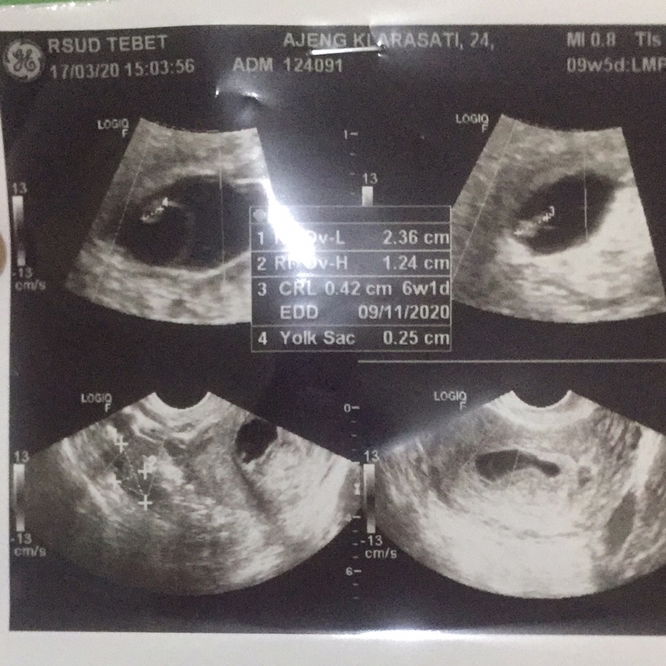 Solusi janin yang tidak berkembang !