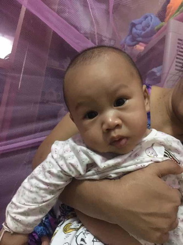 ลูกน้อยคอเอียง