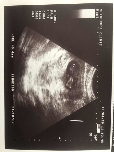 ภาวะแท้งคุกคาม