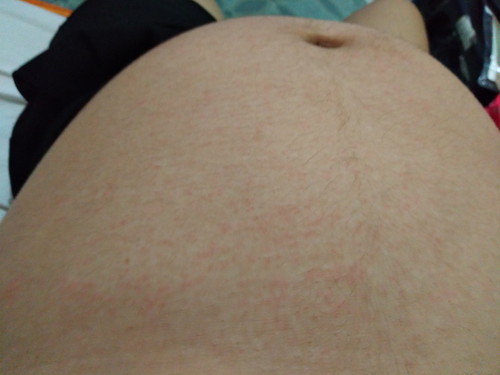 Rashes