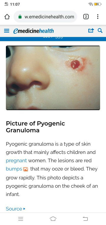 pyogenic granuloma