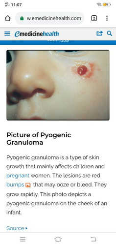 pyogenic granuloma