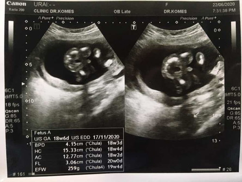 แม่ๆอวดรูปซาวกันหน่อยค่ะว่าได้ผู้ชายหรือผู้หญิง