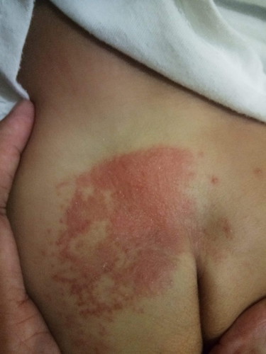 Rashes
