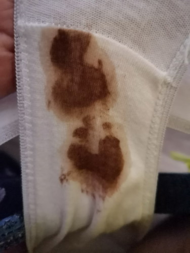 Dark Brown Discharge